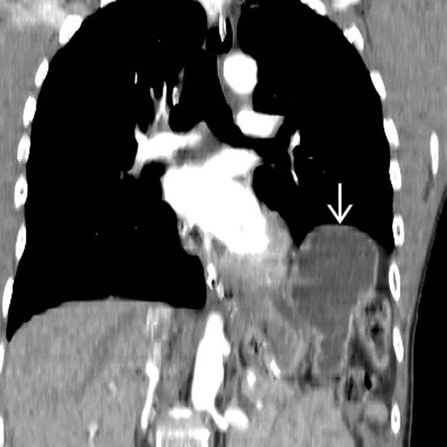 Traumatic Diaphragmatic Rupture Radiology Key