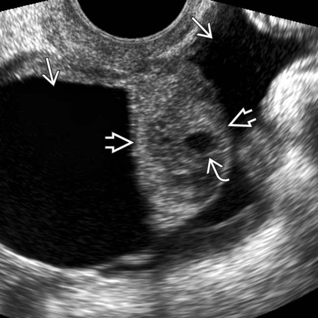 Peritoneal Inclusion Cyst Radiology Key