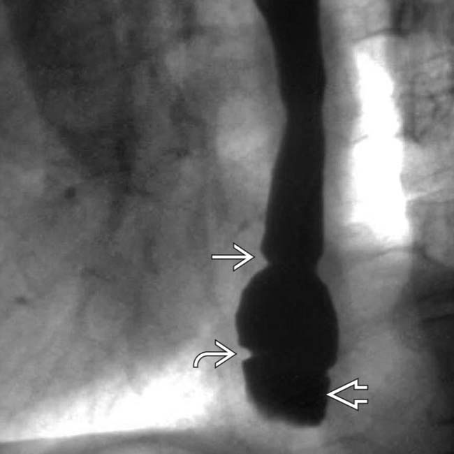 Imaging Approach to the Esophagus Radiology Key