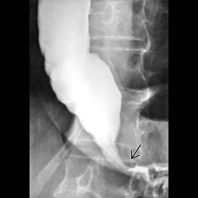 Esophageal Achalasia Radiology Key