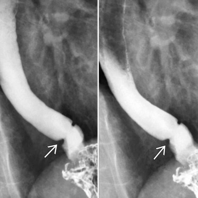 Schatzki Ring Radiology Key