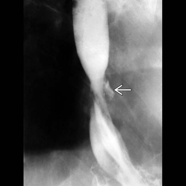 Esophageal Perforation Radiology Key