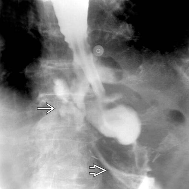 Esophageal Perforation Radiology Key