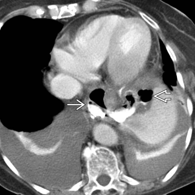 Esophageal Perforation Radiology Key