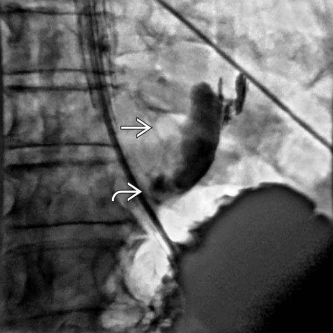 Boerhaave Syndrome Radiology Key