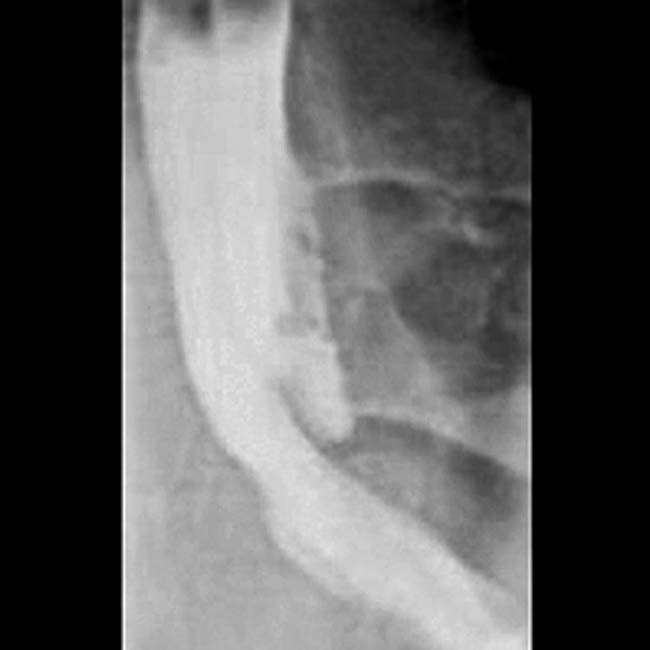 Small Bowel Obstruction Radiology Key