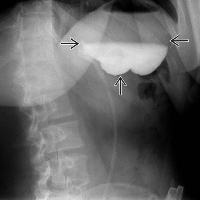 Imaging of Bariatric Surgery Radiology Key