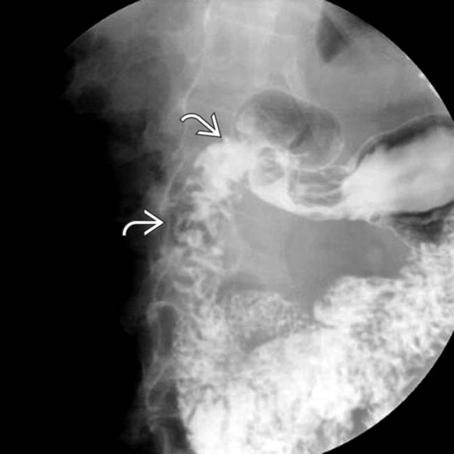 Duodenitis Radiology Key