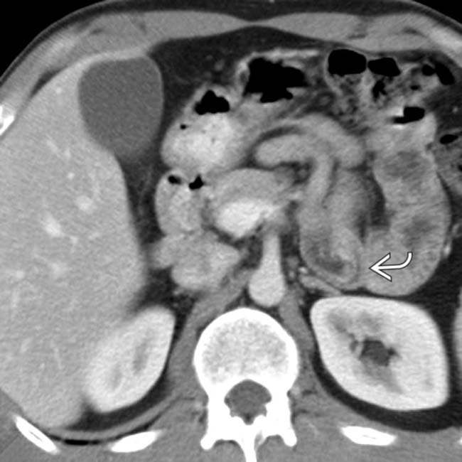 CeliacSprue Disease Radiology Key