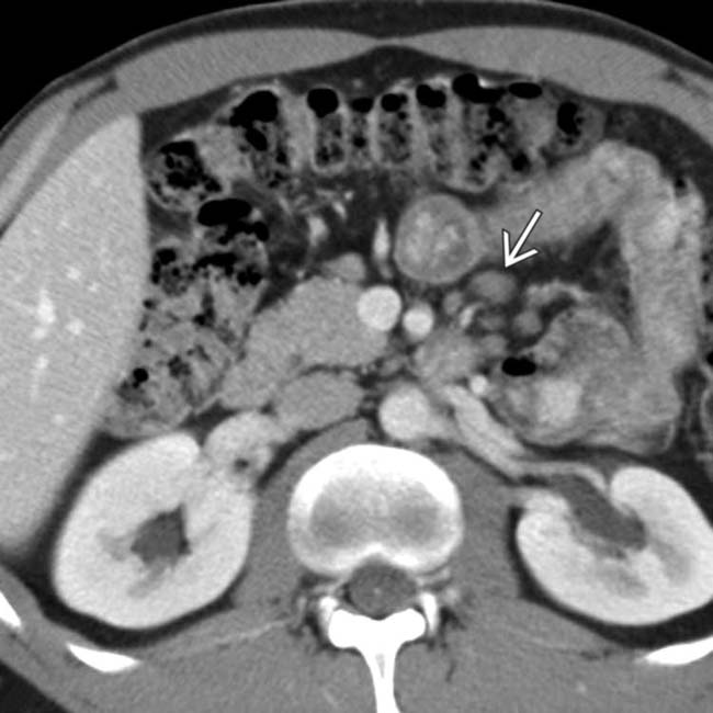 CeliacSprue Disease Radiology Key