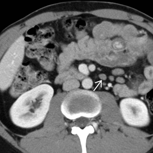 CeliacSprue Disease Radiology Key