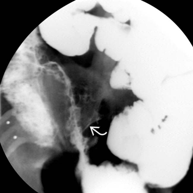 Crohn Disease Radiology Key
