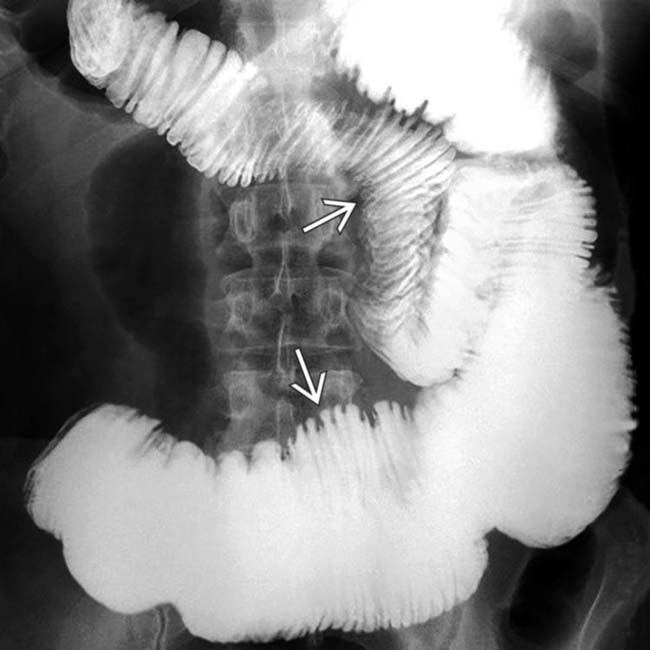 Intestinal Scleroderma Radiology Key