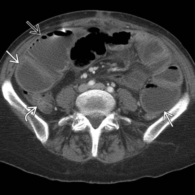 Small Bowel Obstruction Radiology Key