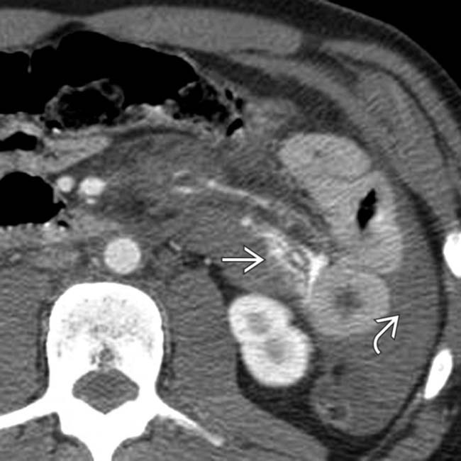 Mesenteric and Small Bowel Trauma Radiology Key