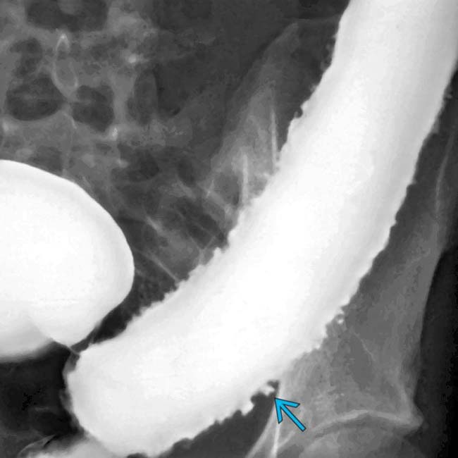 Ulcerative Colitis Radiology Key