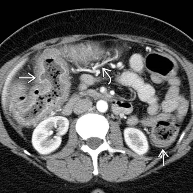 Ulcerative Colitis Radiology Key