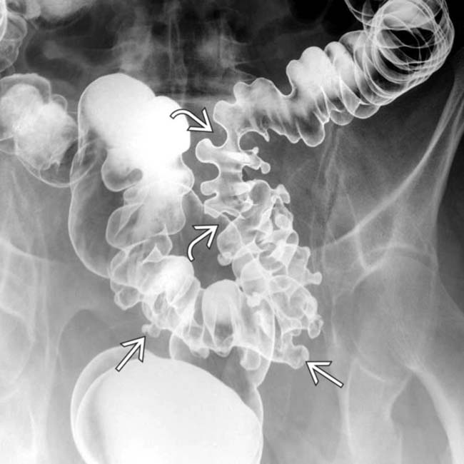 Diverticulosis X Ray