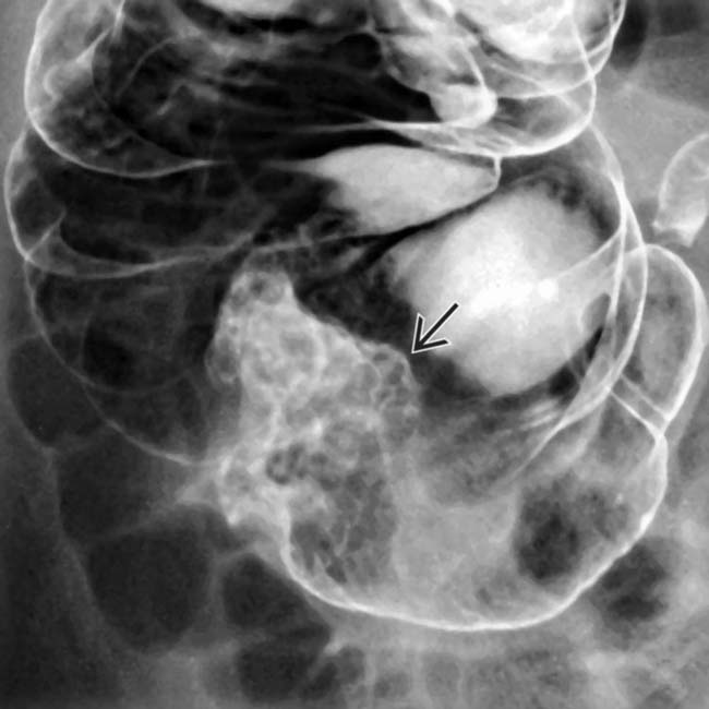 Colonic Polyps Radiology Key