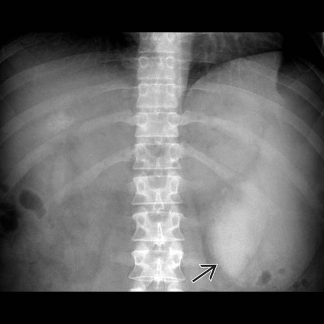 Enlarged Spleen X Ray My XXX Hot Girl