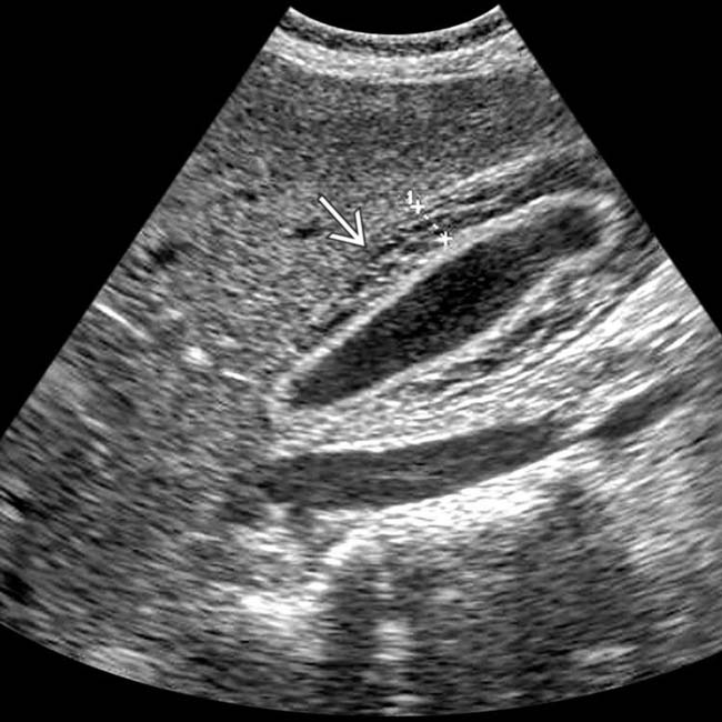 Liver Ultrasound Hepatitis