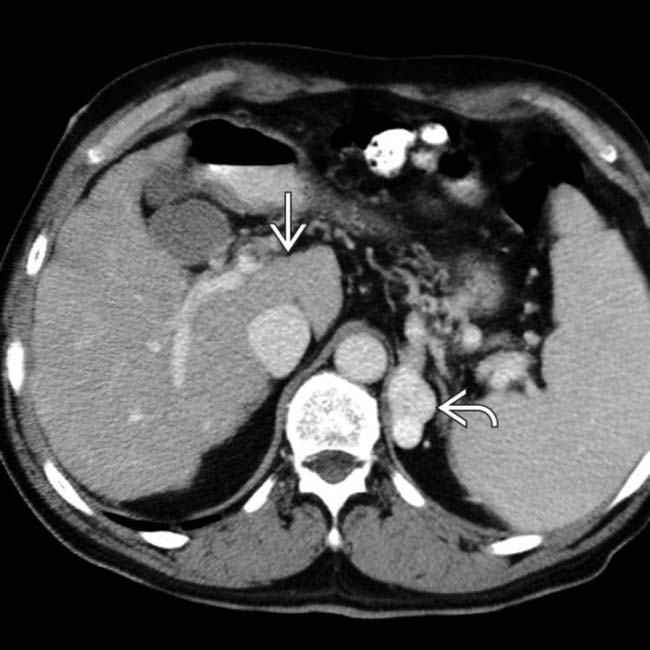 Cirrhosis Radiology Key