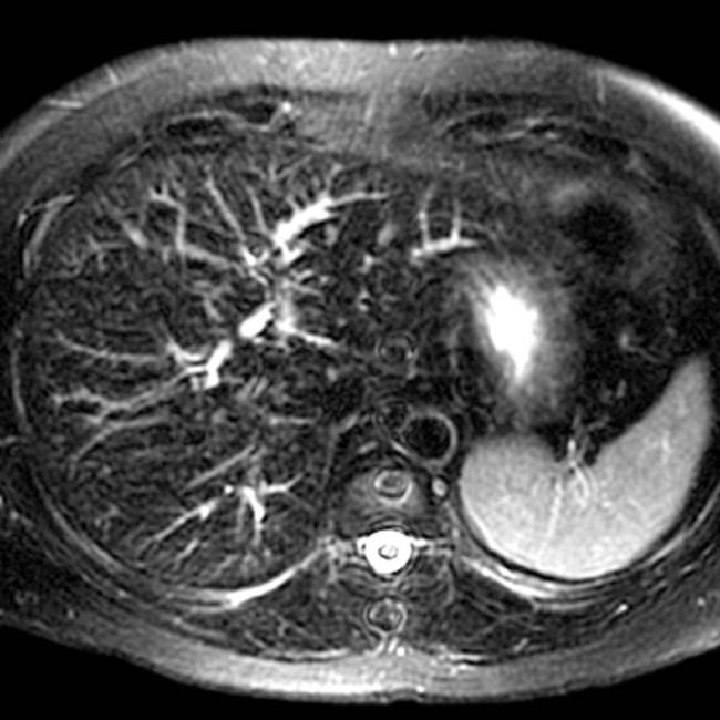 Hemochromatosis Radiology Key