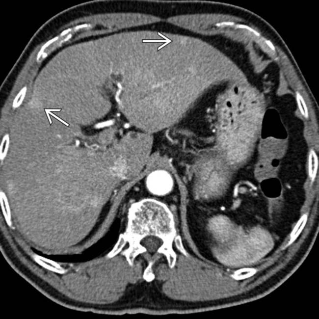 Portal Venous Shunt Liver