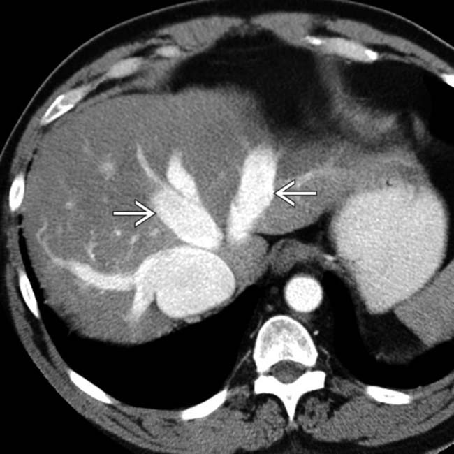 Dilated Hepatic Veins Ultrasound