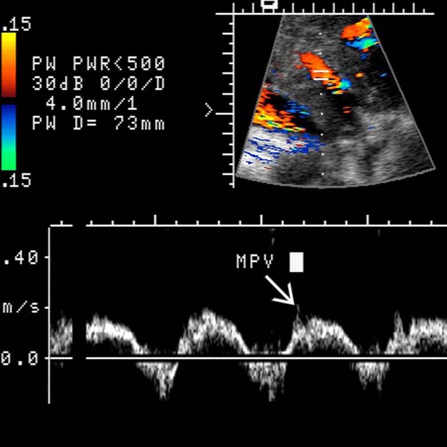 Passive Hepatic Congestion Radiology Key