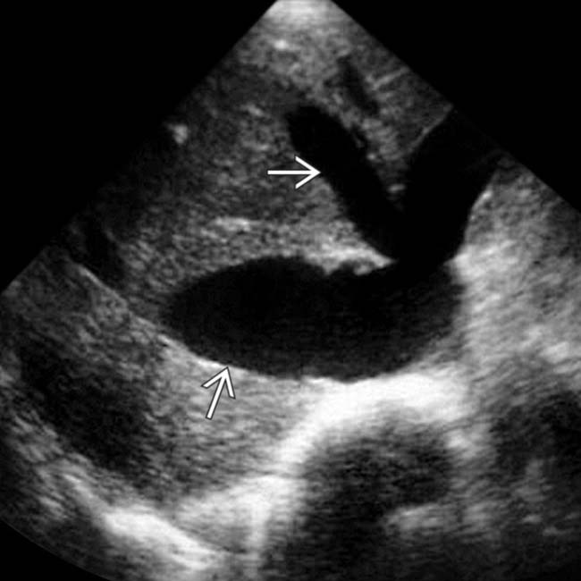 Hepatic Veins On Ultrasound