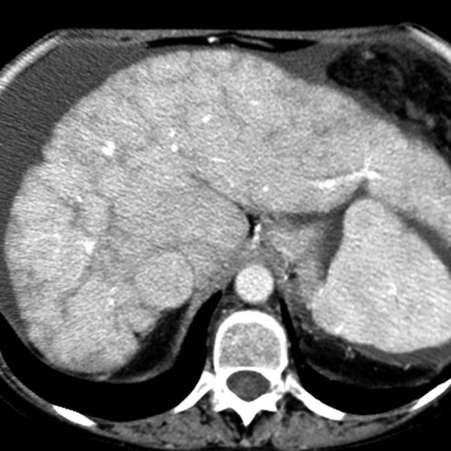 Passive Hepatic Congestion Radiology Key