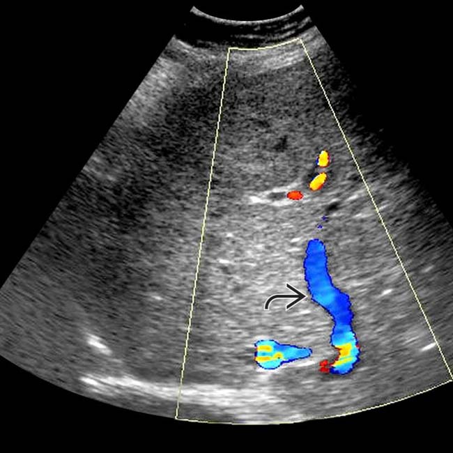 BuddChiari Syndrome Radiology Key