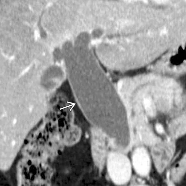 Choledochal Cyst Radiology Key