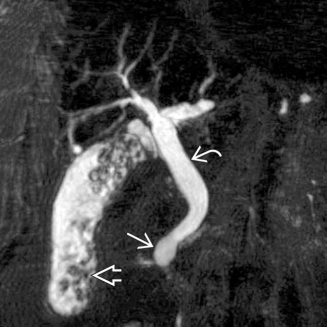 Choledochal Cyst Radiology Key