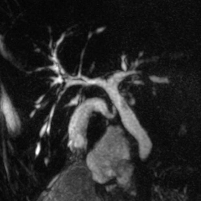 Primary Sclerosing Cholangitis Radiology Key