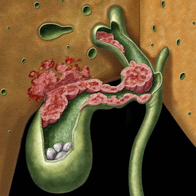 Albums 101+ Pictures Pictures Of Benign Bladder Tumors Full HD, 2k, 4k