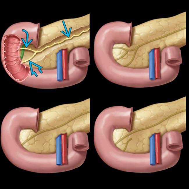 Pancreas Divisum Radiology Key