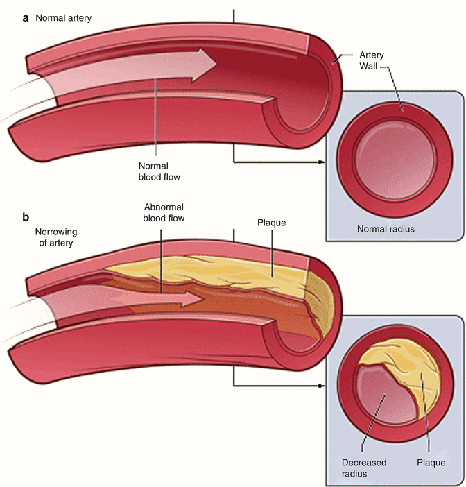 Physiology of Coronary Blood Flow Radiology Key