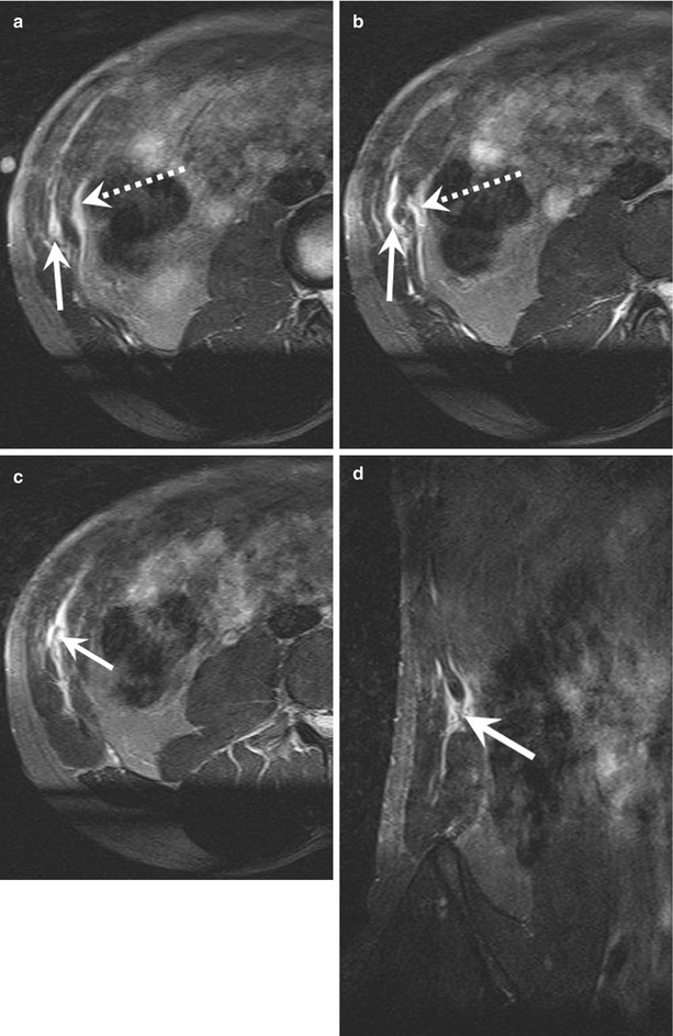 Imaging of Rugby Injuries Radiology Key