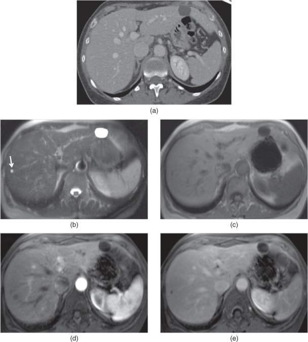 Cystic diseases of the liver Radiology Key