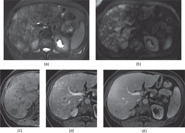 Liver metastases Radiology Key