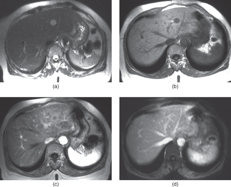 Liver metastases Radiology Key