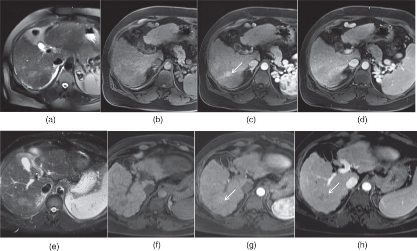 Chronic hepatitis and liver cirrhosis Radiology Key