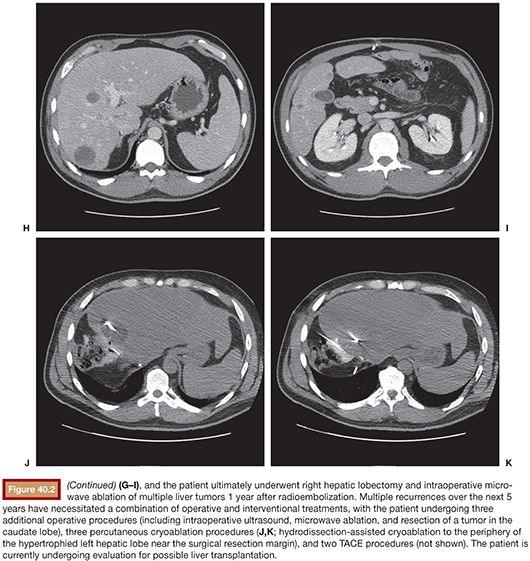 Neuroendocrine Tumors Radiology Key
