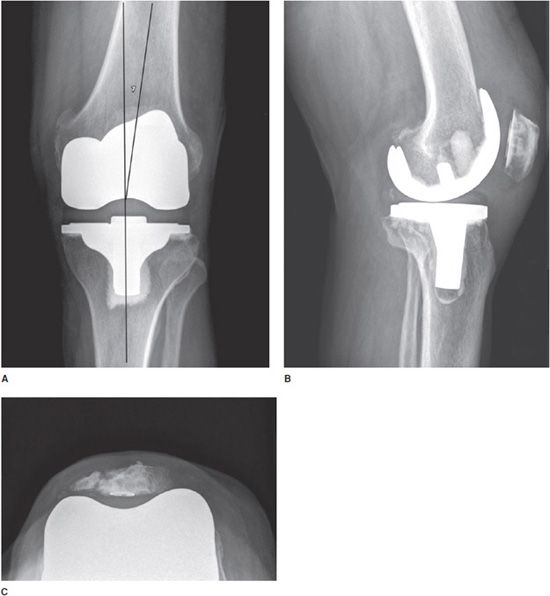 Removal Of Orthopedic Hardware