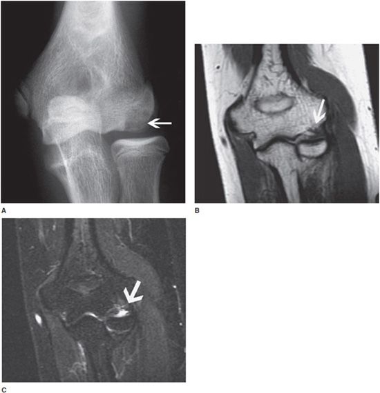 Elbow MRI Radiology Key