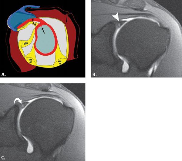 Miscellaneous Conditions of the Shoulder Radiology Key