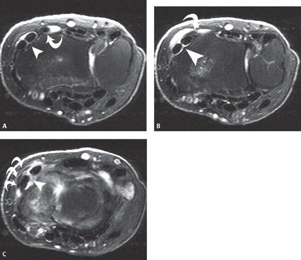 Icd 10 Code For Laceration Right Long Finger