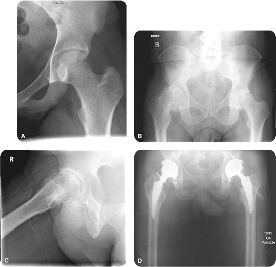 Degenerative Hip Disease (Osteoarthritis) Radiology Key